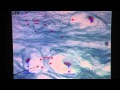 Fibrocartilage Connective Tissue